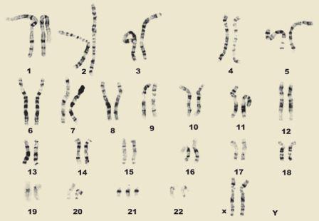 Trisomy 21 Karyotype Female - Copy